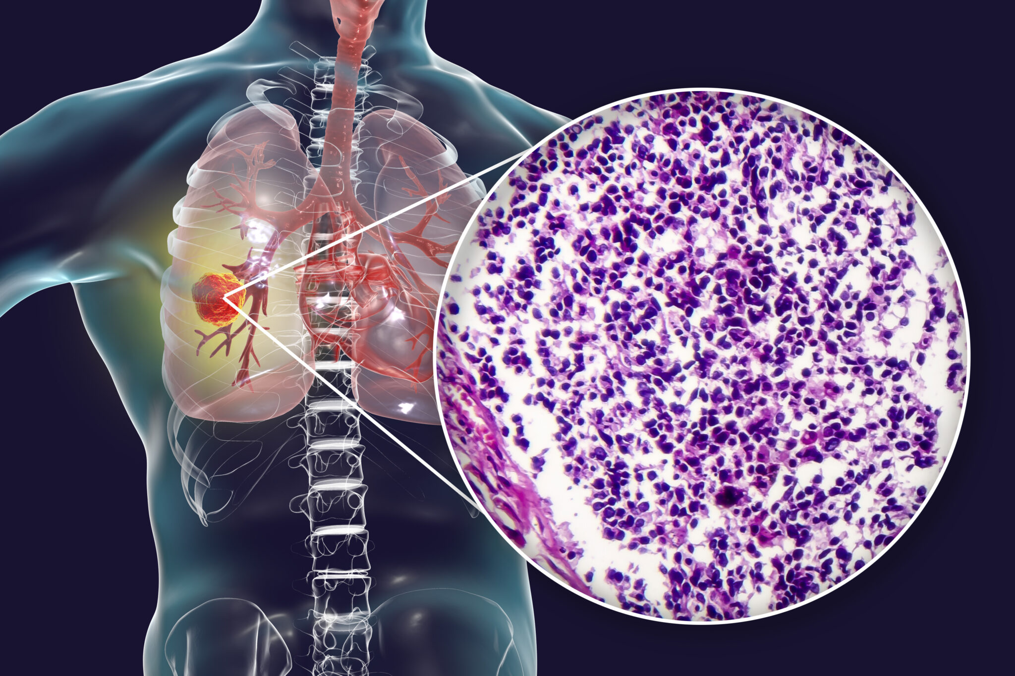 Novel Target Protein Discovered To Treat Small Cell Lung Cancer 