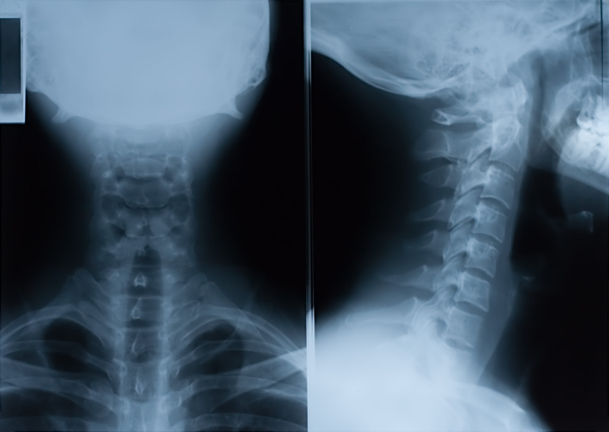 gene-mutations-and-neoantigens-in-head-and-neck-tumors-oncotarget