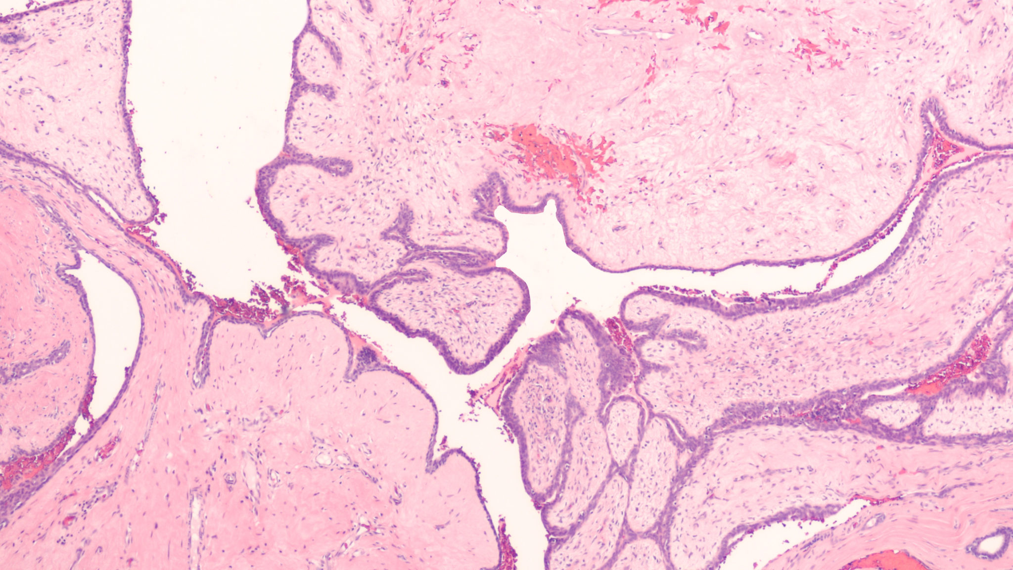 trending-with-impact-benign-borderline-and-malignant-breast-tumors