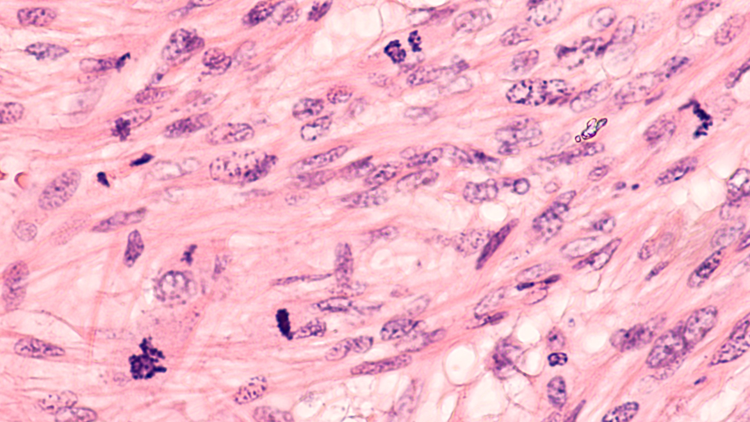 A New Potential Network of Biomarkers Useful Across Sarcomas | Oncotarget