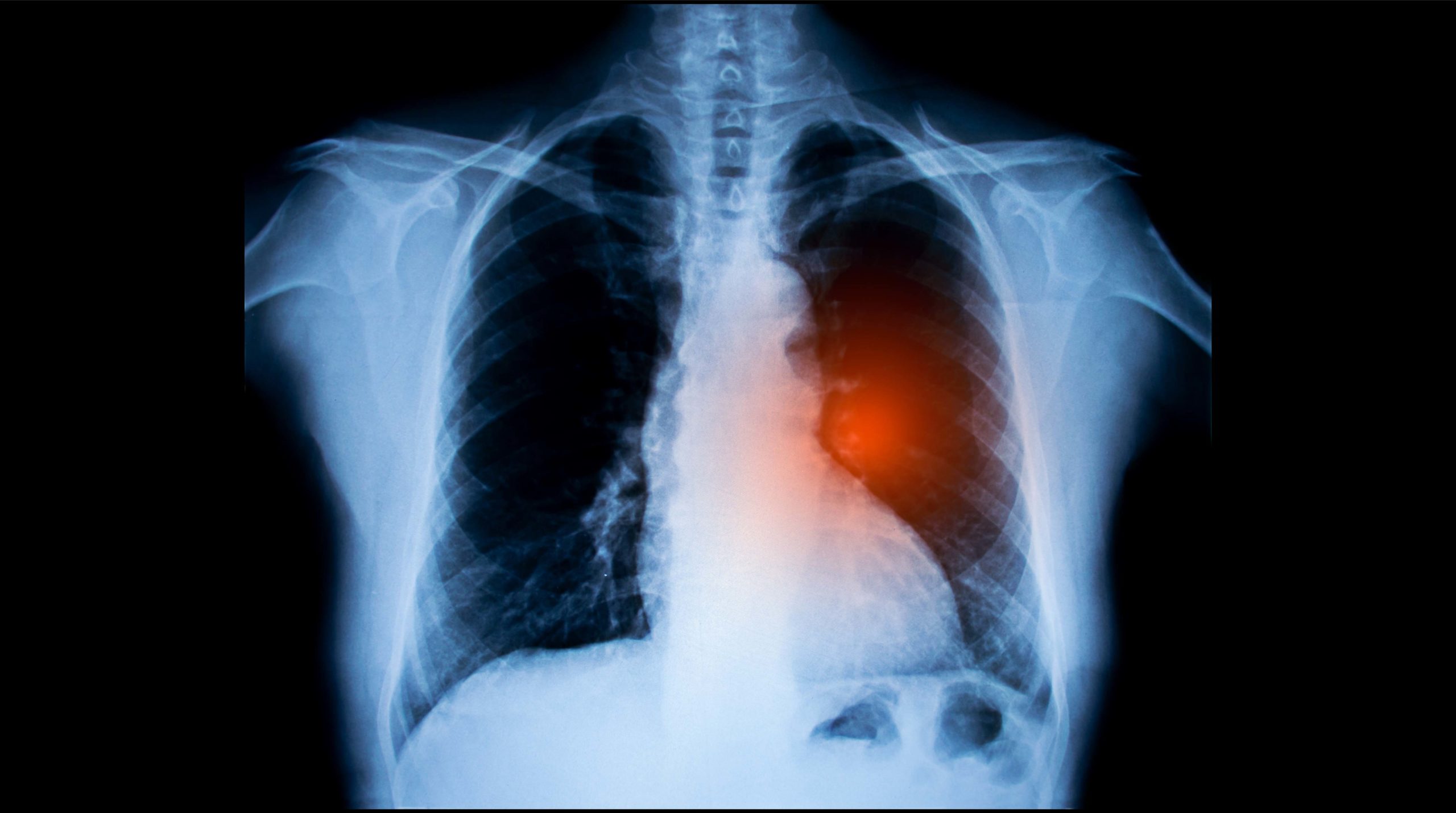 New Study: ALK Rearrangement Among Lung Cancer Patients | Oncotarget