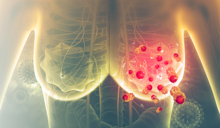 Trending With Impact: Are NOTCH1 Variants Prognostic in Breast Cancer ...