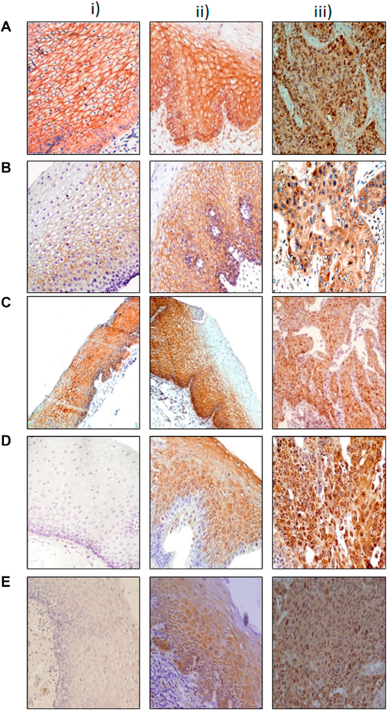 Figure 1: Immunohistochemical analysis of Wnt protein in esophageal tissues.